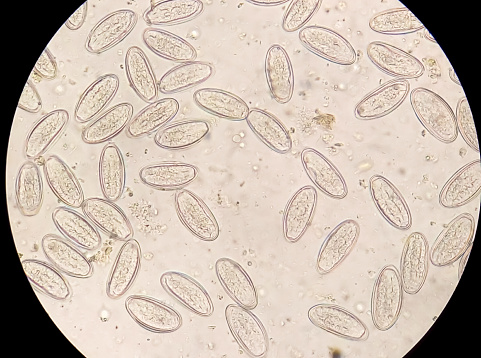 Enterobius vermicularis (EV) eggs. parasite in stool, image under light microscopy 40X objective at medical laboratory.