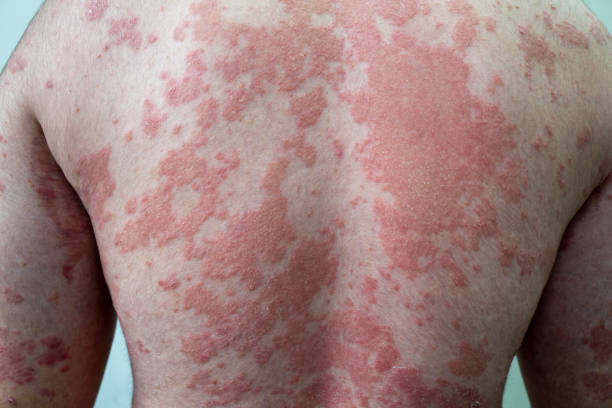 Psoriasis Psoriasis psoriasis stock pictures, royalty-free photos & images