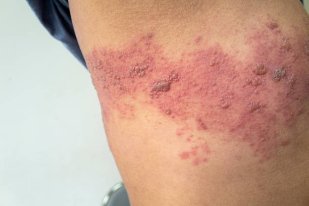 Shingles Shingles herpes stock pictures, royalty-free photos & images