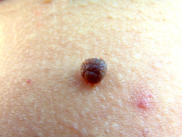 istock papilloma on a person's skin 1332884749