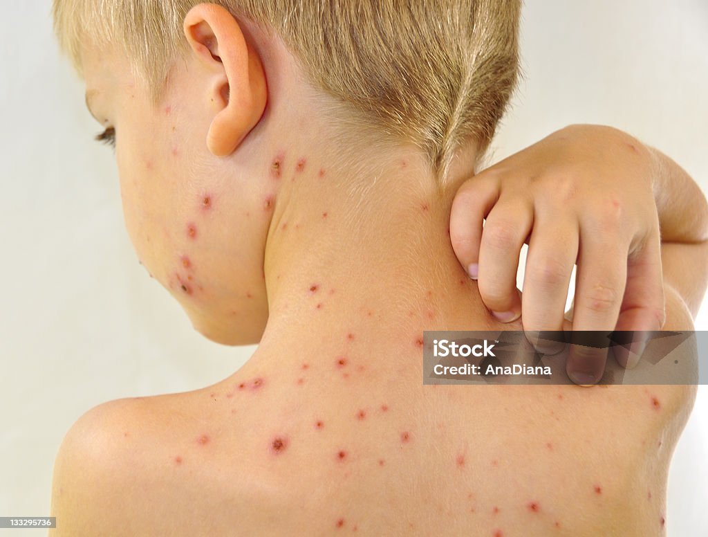 Little boy scratching me his chickenpox Upper back of young boy, 5 years, blond short hair, with red chickenpox on his shoulders, neck and cheek. He is scratching his back with right hand. Chickenpox Stock Photo