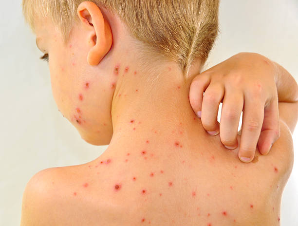 Little boy scratching me his chickenpox stock photo