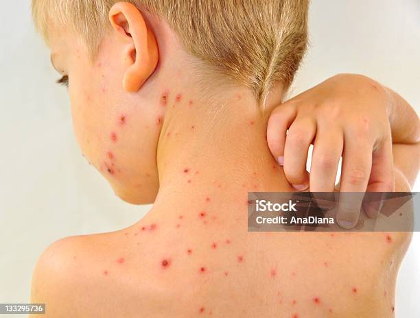 Little Boy Scratching Me His Chickenpox Stock Photo - Download Image Now - Chickenpox, Child, Back