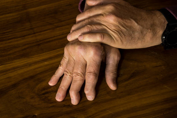 The hands of a male with Psoriatic Arthritis The hands of a male with Psoriatic Arthritis showing deviation of ulnar metacarpal joints. arthritis stock pictures, royalty-free photos & images