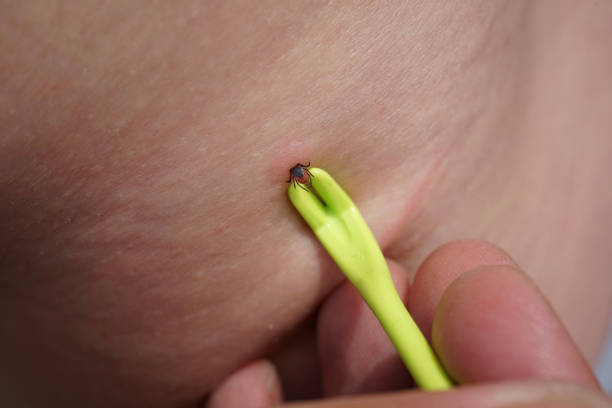 Removal of sucking tick, Ixodes ricinus, from human skin with yellow tweezers stock photo