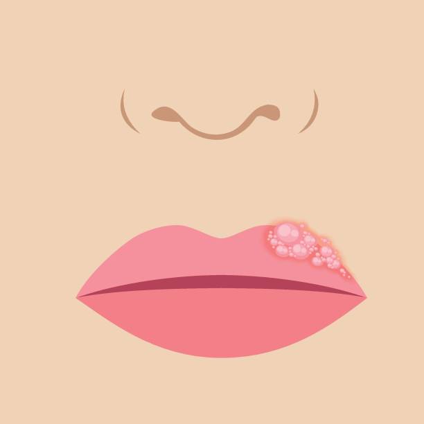 herpes on the lip lips closeup with cold herpes, sore on the lip herpes stock illustrations