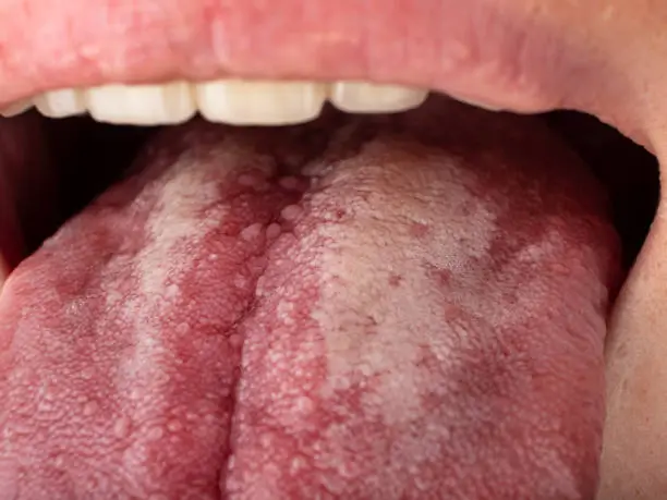 tongue with stomatitis close up, oral cancer.