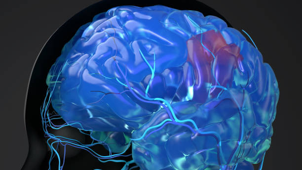istock Brain Cancer, head with tumor inside brain with blood vessels, 3d illustration 1333477697
