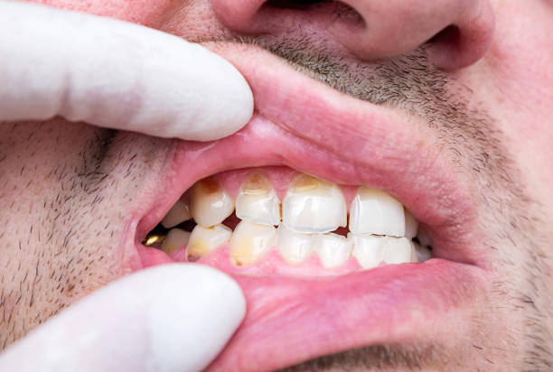 Chipped and cracked tooth enamel, enamel hypoplasia, malocclusion. Bad teeth of a middle-aged man. stock photo