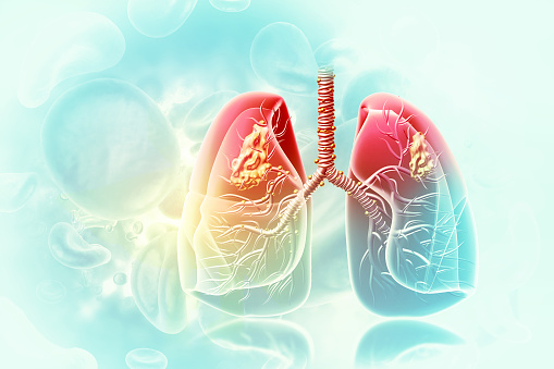 Ilustración médica que muestra cáncer de pulmón o carcinoma bronquial. Ilustración 3D photo
