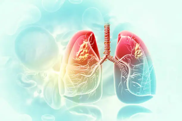 Medical Illustration showing lung cancer or bronchial carcinoma. 3d illustration