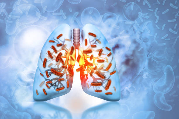istock Virus and bacteria infected the Human lungs, lung disease, 3d illustration 1333532875
