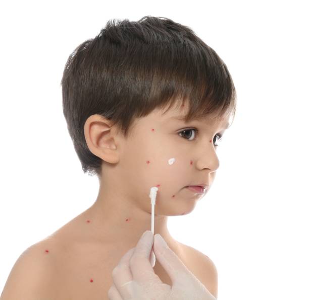 arzt, der creme auf die haut eines kleinen jungen mit windpocken vor weißem hintergrund aufträzt. varicella zoster virus - chickenpox skin condition baby illness stock-fotos und bilder