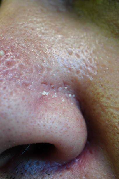 istock Close-up of pimple on nose 1333579843