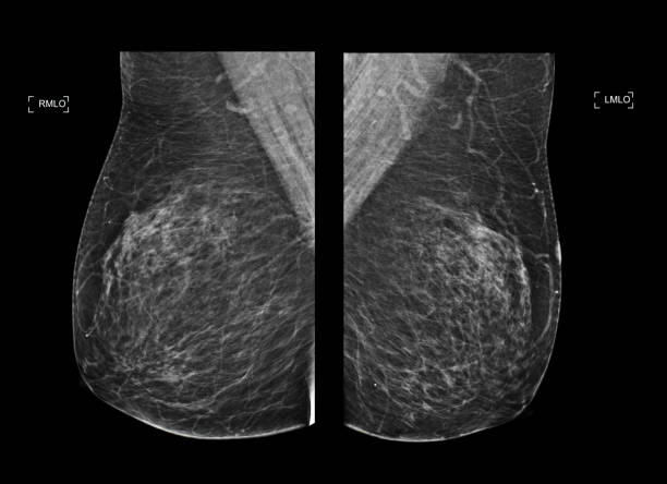 여성에서 횡격막 유방암에 대한 유방 cc 보기의 x 선 디지털 유방 x선 사진 또는 유방 조영술 양면 - lactiferous duct 뉴스 사진 이미지