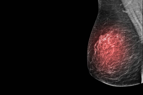 radiographie mammographie numérique ou mammographie des deux côtés de la vue mlo du sein pour le diagnostic cancer du sein chez les femmes isolées sur fond noir. - lactiferous duct photos et images de collection