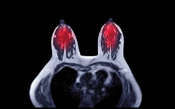 risonanza magnetica o risonanza magnetica t1w assiale del seno nelle donne per lo screening del cancro al seno. - lactiferous duct foto e immagini stock
