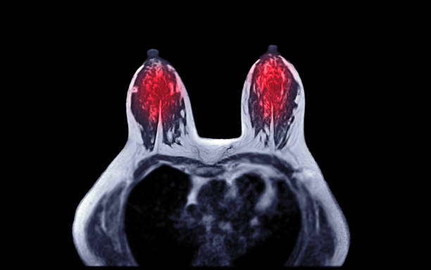 유방암 을 검열하기 위한 여자에 있는 유방 mri 또는 자기 공명 화상 진찰 축 t1w. - lactiferous duct 뉴스 사진 이미지