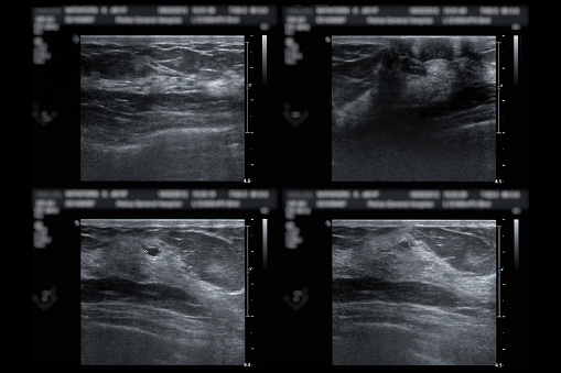 ultrasound of breast  after mammography  for diagnosis Breast cancer in women isolated on black background.