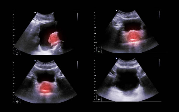 Ultrasound of urinary bladder  or KUB for  screening  renal and bladder disease. Ultrasound of urinary bladder  or KUB for  screening  renal and bladder disease. bladder cancer stock pictures, royalty-free photos & images
