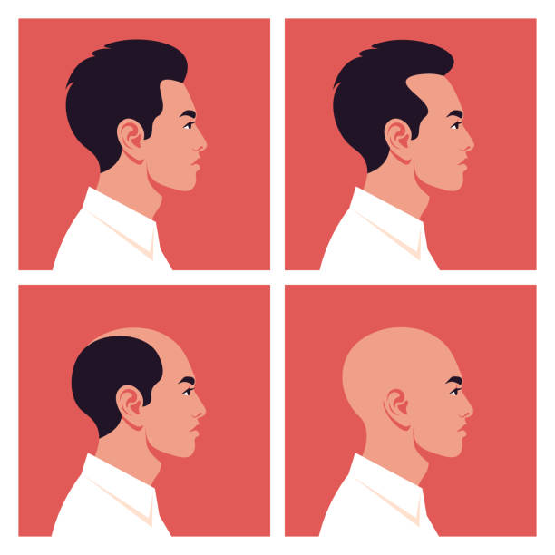ilustrações, clipart, desenhos animados e ícones de estágios de calvície. alopecia. perfis de homens asiáticos. - alopecia antes depois
