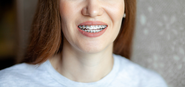 La sonrisa de una chica joven y hermosa con tirantes en sus dientes blancos photo