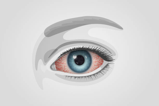 Reddened human eye with many distinct blood vessels vector art illustration