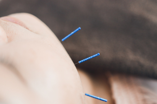 Hand with a plastic glove holding an acupuncture needle close up