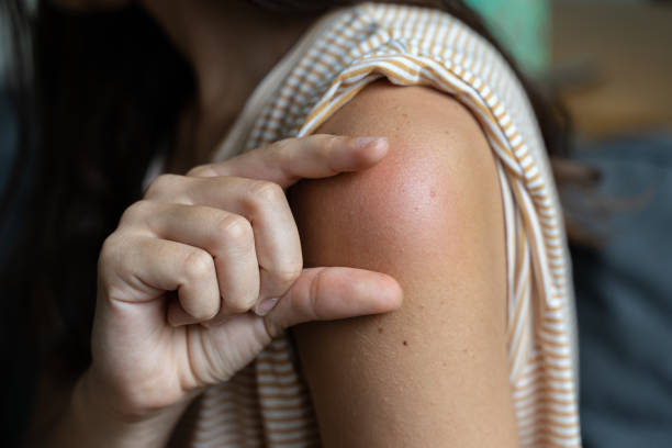 Side effect of the vaccine - shoulder skin redness and pain. Covid-19 vaccination reaction. Woman skin itchy and swelling after vaccine shot stock photo