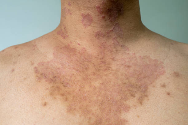 istock Tinea corporis 1333957497