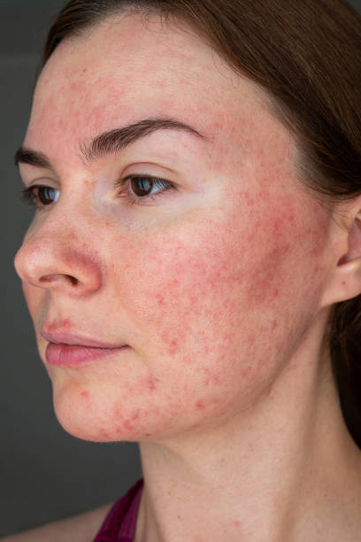 papulopustular rosacea, face close up