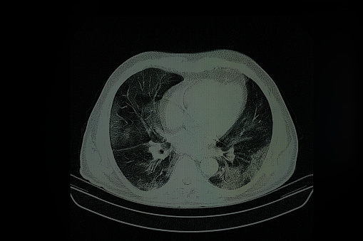 Ct image of human lung on computer monitor in radiology clinic. A thorax ct image of patient with covid-19 disease is seen. Shot indoor with a full frame mirrorless camera.