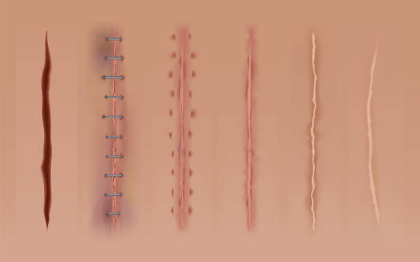 Set of healing wounds, skin scars, stitched gash and cuts. Realistic surgical sutures, stitched wounds at different healing stages. Collection of ruptures in body tissue Set of healing wounds, skin scars, stitched gash and cuts. Realistic surgical sutures, stitched wounds at different healing stages. Collection of ruptures in body tissue. skin scrape stock illustrations