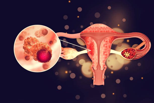 Female reproductive system diseases. Uterus cancer and endometrial malignant tumor as a uterine medical concept. 3d illustration Female reproductive system diseases. Uterus cancer and endometrial malignant tumor as a uterine medical concept. 3d illustration fallopian tube stock pictures, royalty-free photos & images