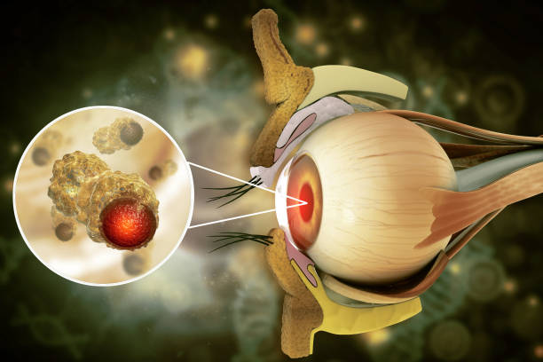 istock Eye cancer, eye disease, 3d illustration 1334434697