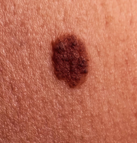 Large mole on human skin. Mole removal concept. Close-up, selective focus stock photo