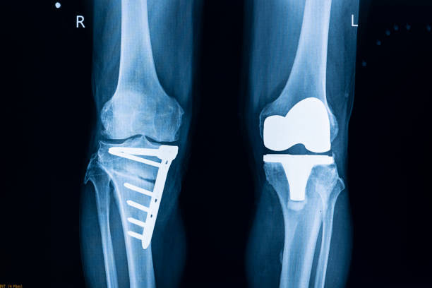 X-ray film of a patient after total left knee replacement surgery. X-ray film of a patient after total left knee replacement surgery and plate and screws fixation of fractured right tibia. TKA operation and knee prosthesis. artificial knee photos stock pictures, royalty-free photos & images