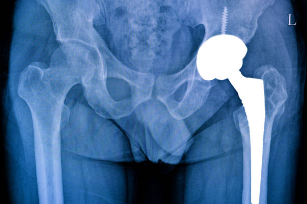 röntgenfilm eines patienten mit totaler operation der linken hüfte . - hip replacement stock-fotos und bilder