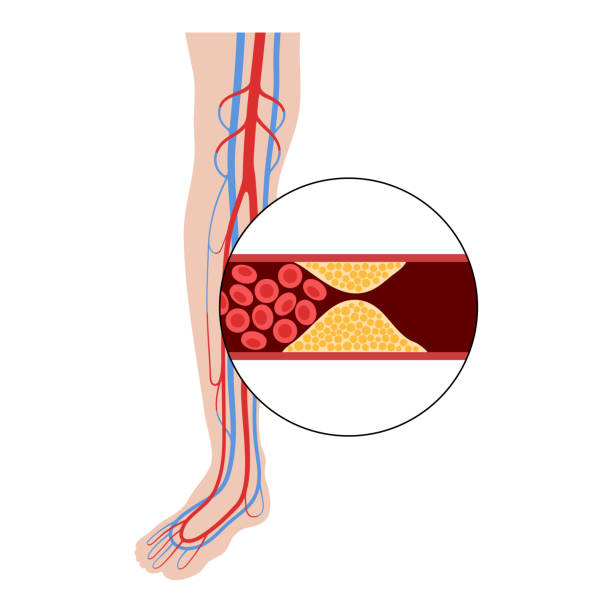 Peripheral artery disease PAD Peripheral artery disease. Ischemia in leg. Cholesterol in human blood vessel. PAD concept. Fat cells in vein artery. Blocked vascular in man body. Medical poster for clinic flat vector illustration clogged artery stock illustrations