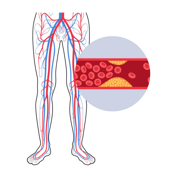 Peripheral artery disease PAD Peripheral artery disease. Ischemia in leg. Cholesterol in human blood vessel. PAD concept. Fat cells in vein artery. Blocked vascular in man body. Medical poster for clinic flat vector illustration clogged artery stock illustrations