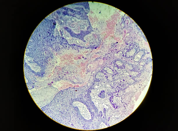 istock Tissue form anal canal (wedge biopsy) histopathology slide microscopic 40x show Basaloid squamous cell carcinoma. 1334771384