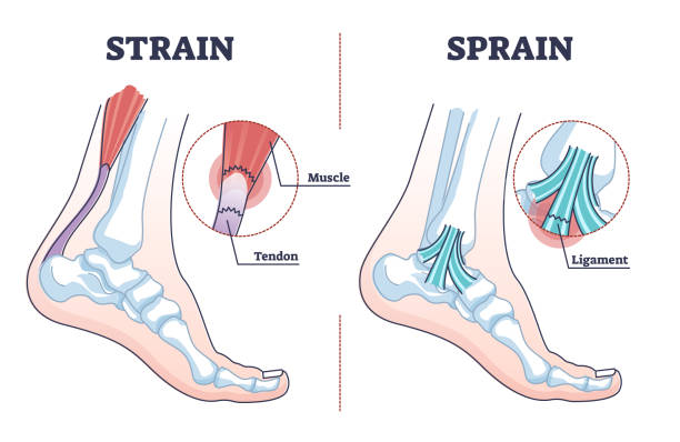 Sprain vs strain anatomical comparison as medical foot injury outline diagram Sprain vs strain anatomical comparison as medical foot injury outline diagram. Labeled educational orthopedic muscle, tendon and ligament problem description vector illustration. Painful foot twist. ankle stock illustrations