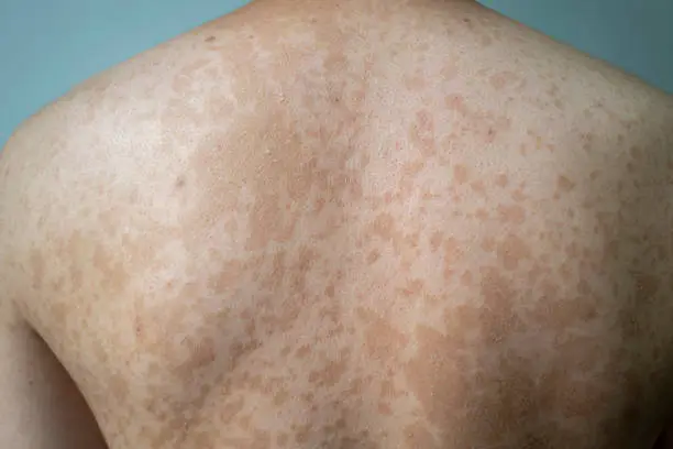 Photo of Tinea versicolor