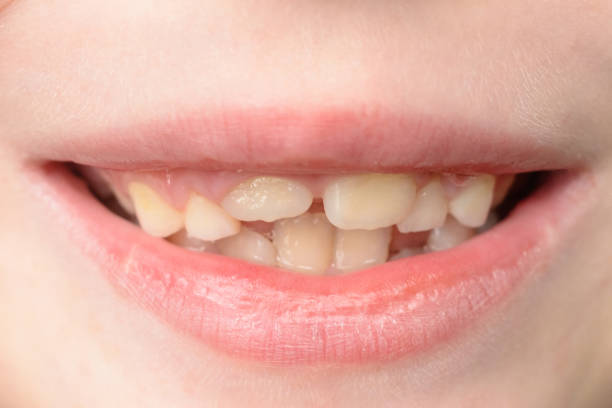 istock Close-up of a small boy with curved teeth smiling 1334973888