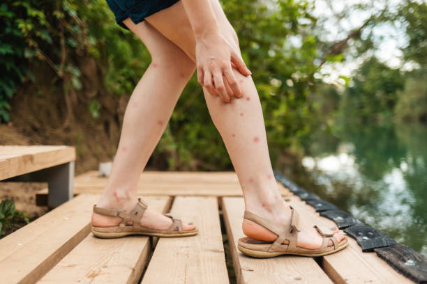 蚊に刺される。女性は噛まれた足を手で掻く。赤い発疹のクローズアップの脚 - flea ストックフォトと画像