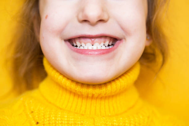 Girl shows her teeth-pathological bite, malocclusion, overbite. Pediatric dentistry and periodontics, bite correction. Health and care of teeth, caries treatment, baby teeth. Upper jaw rests on gum. chica muestra su mordedura patológica de dientes, maloclusión, sobremordida. odontología pediátrica y periodorótica, corrección de mordeduras. salud y cuidado de los dientes, tratamiento de caries, dientes de leche. la mandíbula superior descansa so