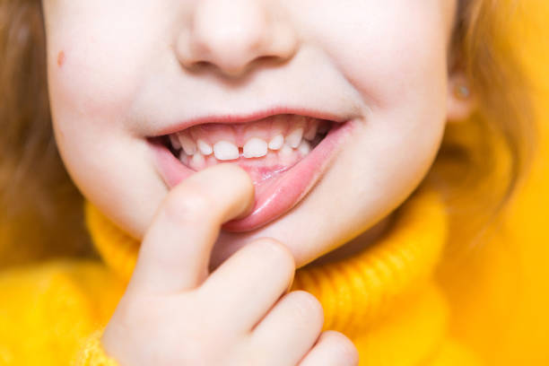 Girl shows her teeth-pathological bite, malocclusion, overbite. Pediatric dentistry and periodontics, bite correction. Health and care of teeth, caries treatment, baby teeth. Upper jaw rests on gum. stock photo