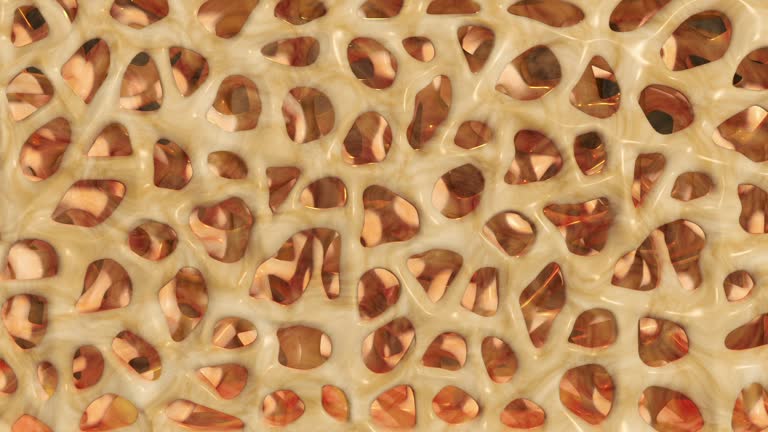3,107 Osteoporosis Stock Videos and Royalty-Free Footage - iStock | Osteoporosis bone, Bone density, Bone 3,107 Osteoporosis Stock Videos and Royalty-Free Footage - iStock | Osteoporosis bone, Bone density, Bone