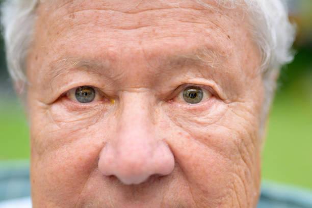 istock Elderly man suffering from anisocoria showing unequal pupils 1335122889