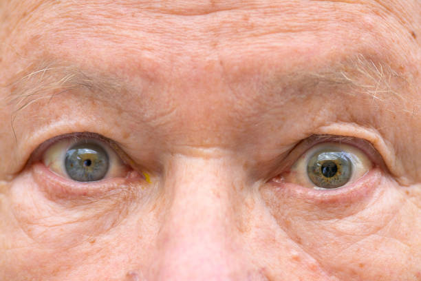 Senior man with anisocoria showing unequal dilation of his pupil Extreme close up of a senior man with anisocoria showing unequal dilation of his pupils caused by disease, trauma or brain tumour dilation stock pictures, royalty-free photos & images